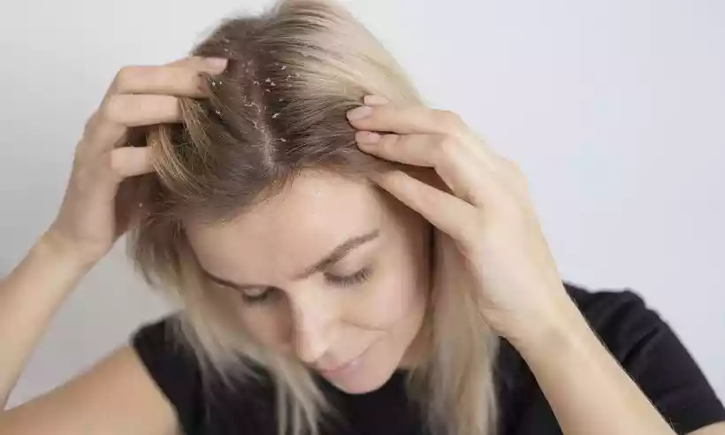 mulher-mostra-caspa-no-cabelo_1_32941